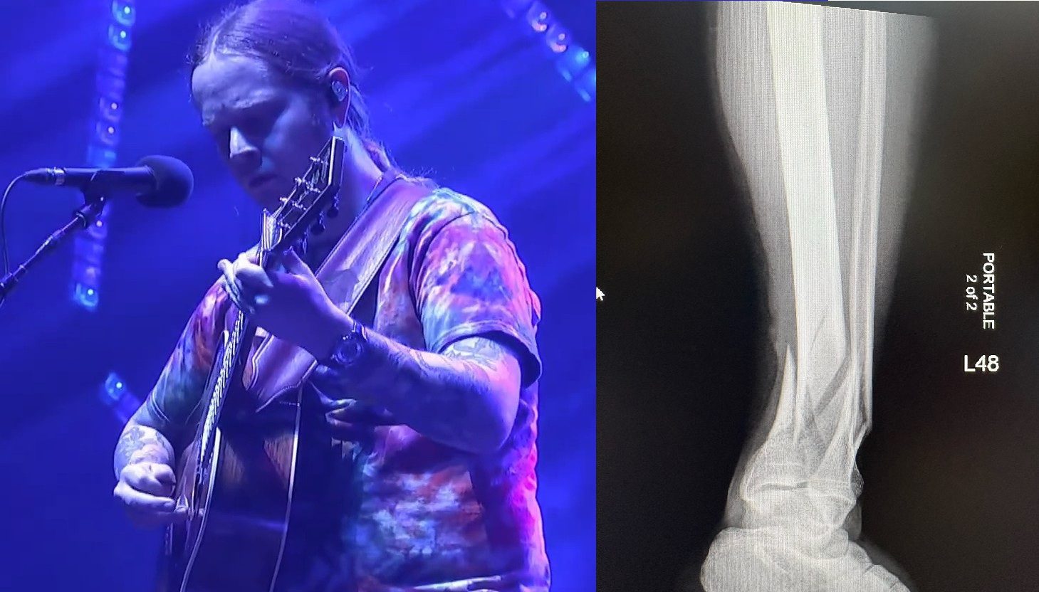 Billy Strings Broke His Leg Right Before The Encore Of Night 2 In Charlottesville, Virginia